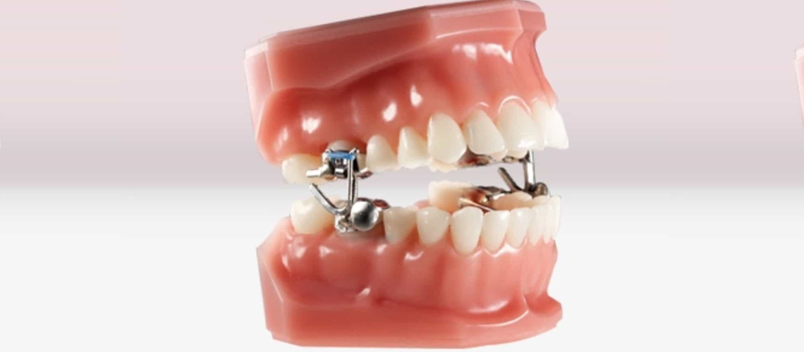 MARA instructions How to correct your jaw with a MARA appliance