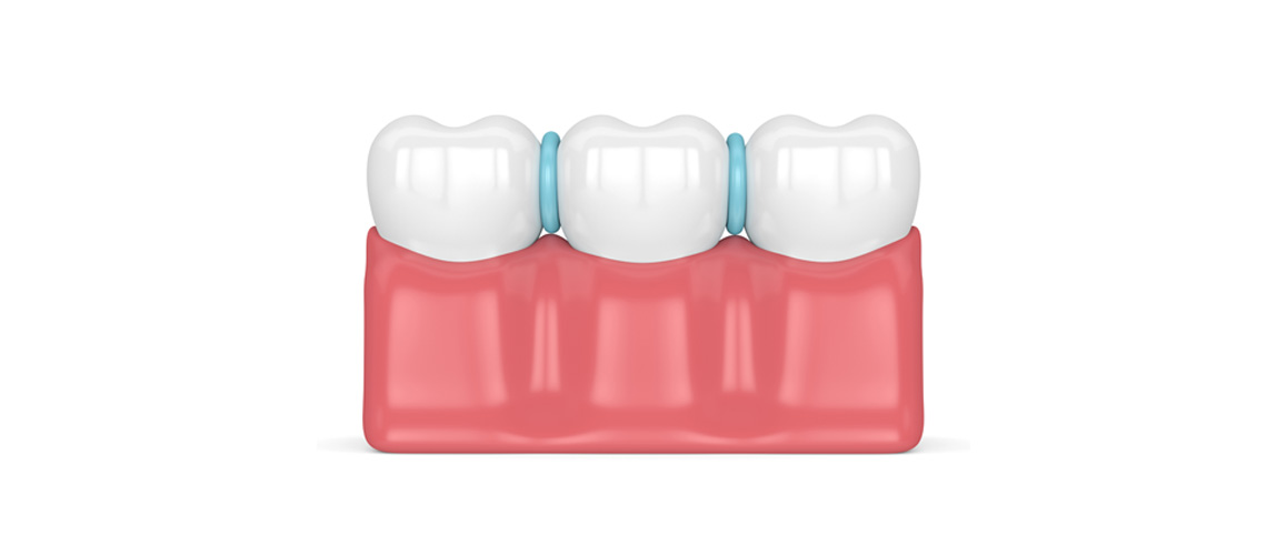What Are Spacers for Braces and How Do They Work? Orthodontic